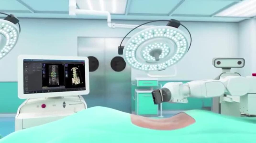 Mazor X Spine Surgery at Coliseum Northside Hospital.mp4  2222